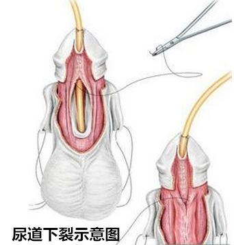 尿道下裂的临床表现有哪些