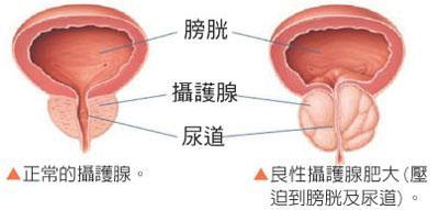 怎么预防前列腺肥大