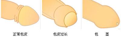 包皮过长怎么治疗