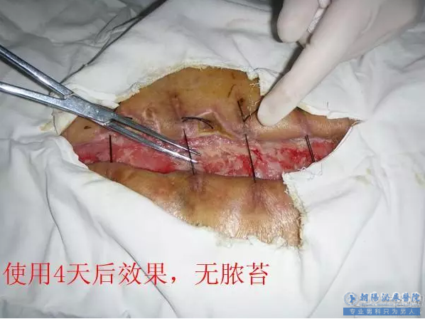 图 3 负压吸引治疗效果显著，脓苔基本消失3