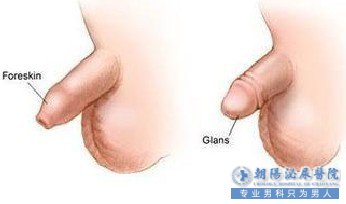 包皮过长术后应注意些什么