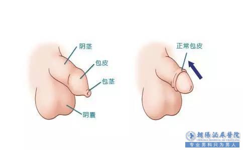 哪种情况是包皮过长