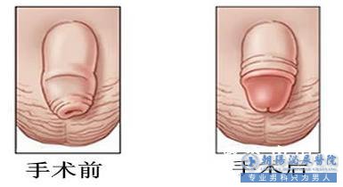 患上包皮过长有哪些危害