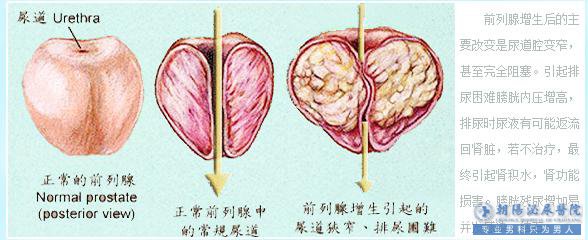 缓解前列腺痛的六种方法,快来学一学